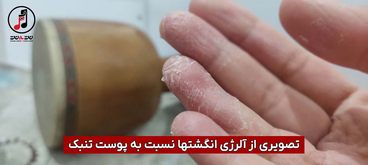 حساسیت دست به پوست تنبک